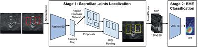 Artificial intelligence for the detection of sacroiliitis on magnetic resonance imaging in patients with axial spondyloarthritis